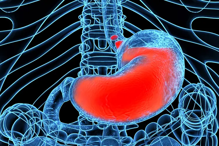 Acid Reflux
