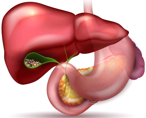 Gallbladder Stones