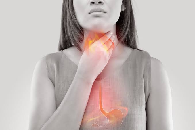 Acid Reflux