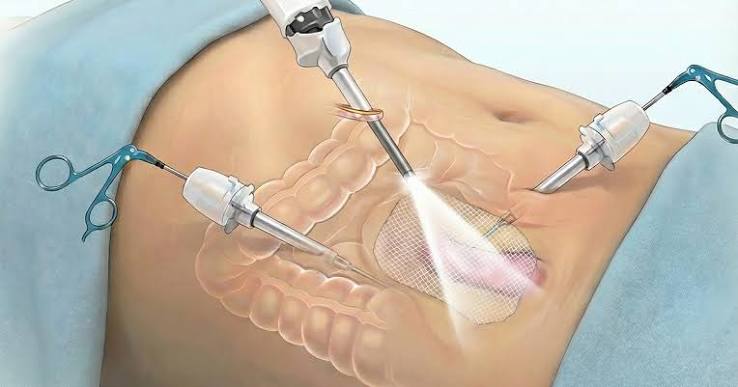 Hernia Repair