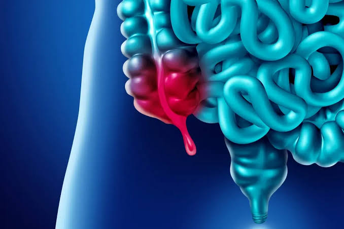 Appendicitis